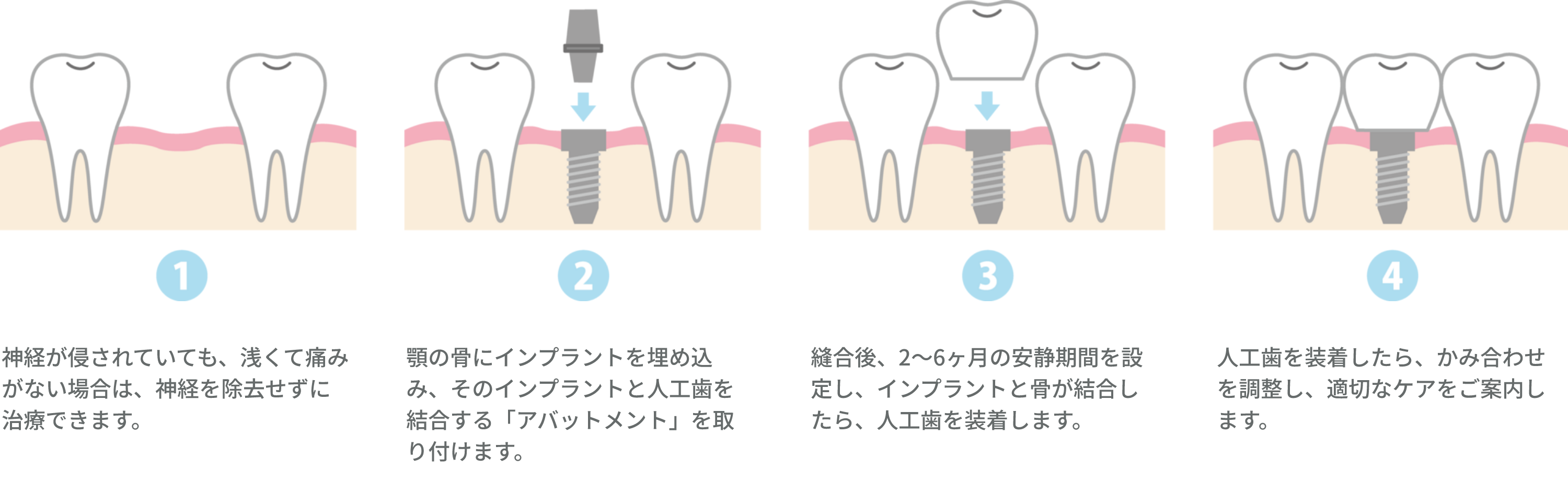 インプラントの流れ