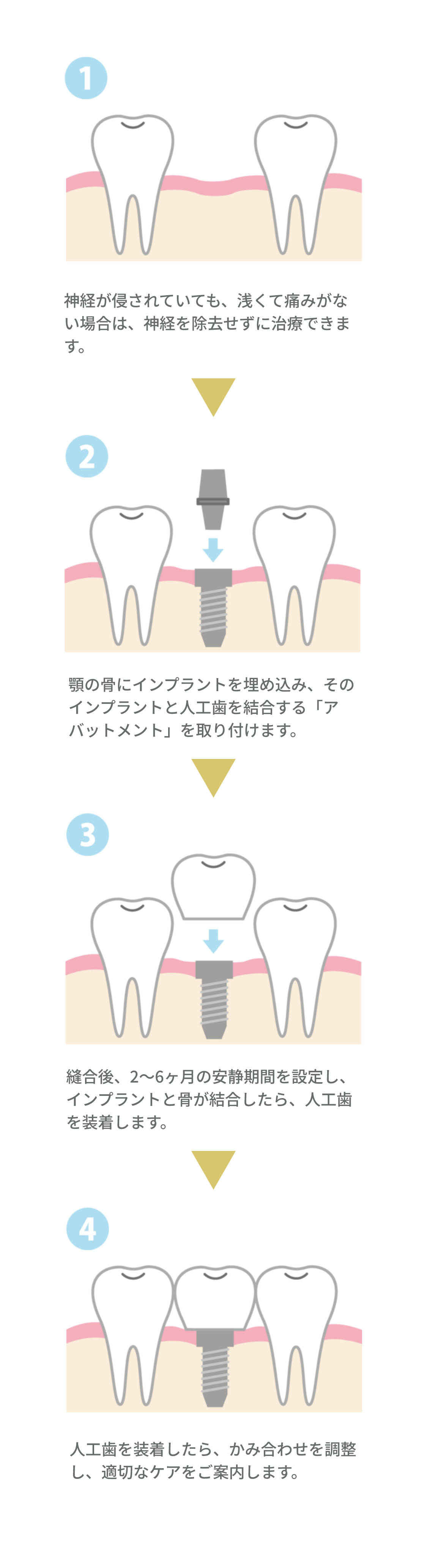 インプラントの流れ